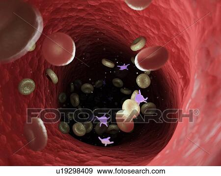 Stock Photo - Diseased blood cells, computer illustration.. Fotosearch