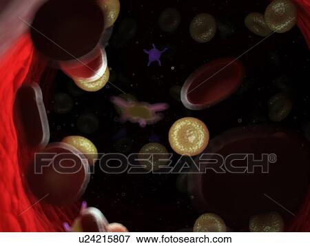 Stock Photo - Diseased blood cells, computer illustration.. Fotosearch