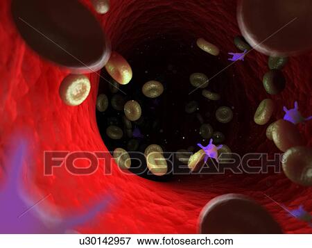 Diseased blood cells, computer illustration. View Large Photo Image Stock Photo - Diseased blood cells, computer illustration.. Fotosearch