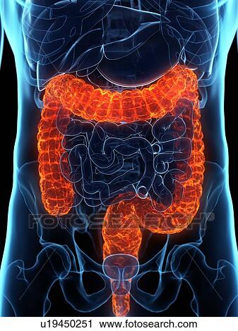 Stock Image - Diseased colon, conceptual illustration. Fotosearch