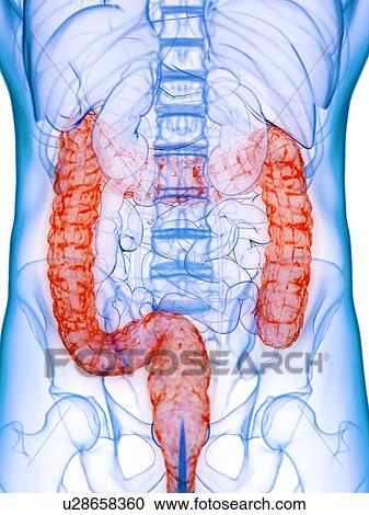 Stock Image - Diseased colon, conceptual illustration. Fotosearch