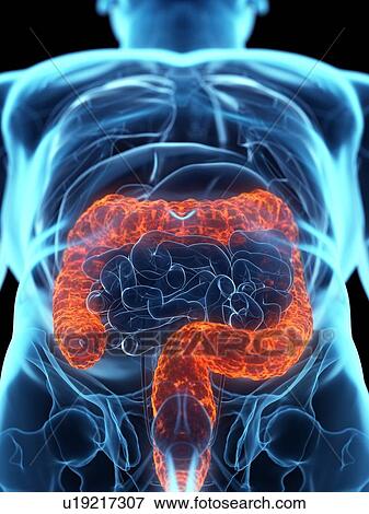 Stock Photo - Diseased colon, conceptual illustration. Fotosearch