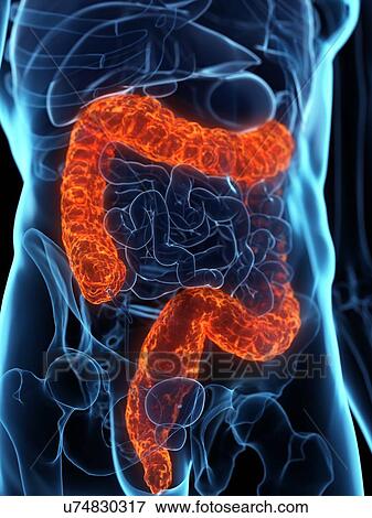 Stock Photo - Diseased colon, conceptual illustration. Fotosearch
