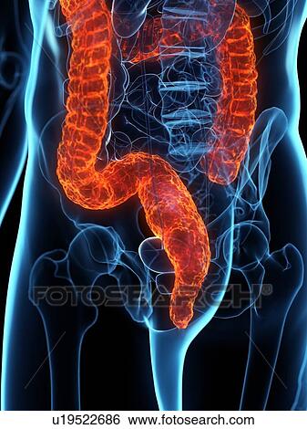 Stock Photograph - Diseased colon, conceptual illustration. Fotosearch