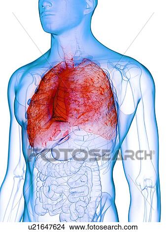 Picture - Diseased lung, conceptual illustration. Fotosearch