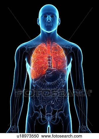 Stock Image - Diseased lung, conceptual illustration. Fotosearch