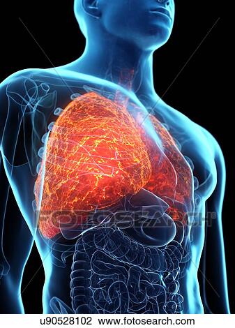 Stock Image - Diseased lung, conceptual illustration. Fotosearch