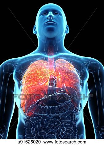 Stock Image - Diseased lung, conceptual illustration. Fotosearch