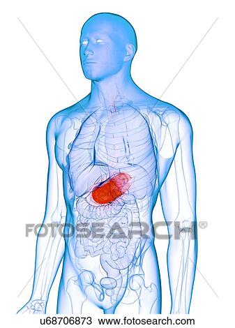 Stock Image - Diseased stomach, conceptual illustration. Fotosearch