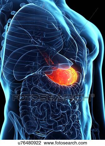 Stock Image - Diseased stomach, conceptual illustration. Fotosearch