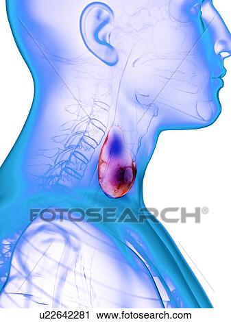 Stock Image - Diseased thyroid gland, conceptual illustration. Fotosearch
