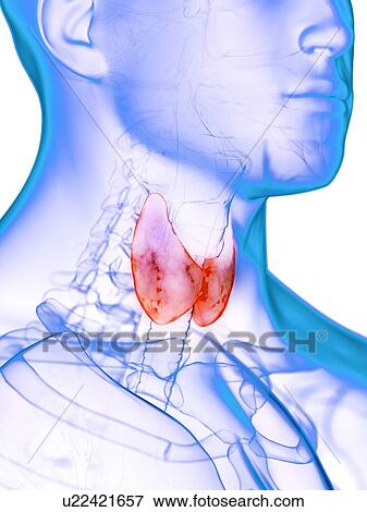 Stock Photo - Diseased thyroid gland, conceptual illustration. Fotosearch