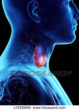 Diseased thyroid gland, conceptual illustration View Large Photo Image Stock Photography - Diseased thyroid gland, conceptual illustration. Fotosearch