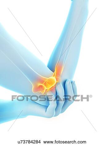 Picture - Elbow pain, conceptual illustration.. Fotosearch