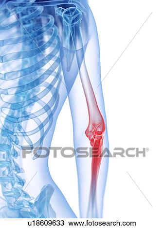 Stock Image - Elbow pain, conceptual illustration. Fotosearch
