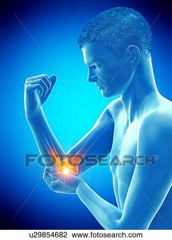 Elbow pain, conceptual illustration. View Large Photo Image Stock Image - Elbow pain, conceptual illustration.. Fotosearch