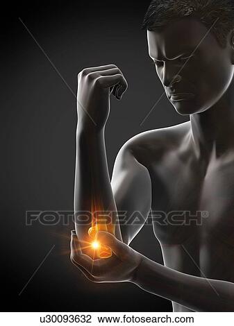 Stock Image - Elbow pain, conceptual illustration.. Fotosearch