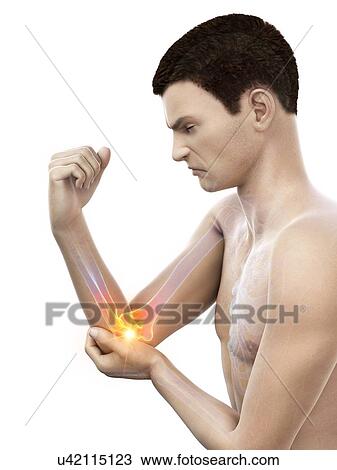 Stock Image - Elbow pain, conceptual illustration.. Fotosearch