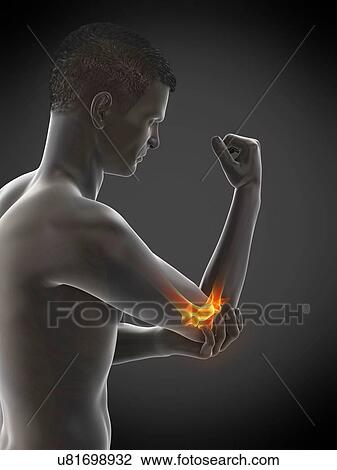 Stock Image - Elbow pain, conceptual illustration.. Fotosearch