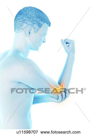 Stock Photo - Elbow pain, conceptual illustration.. Fotosearch