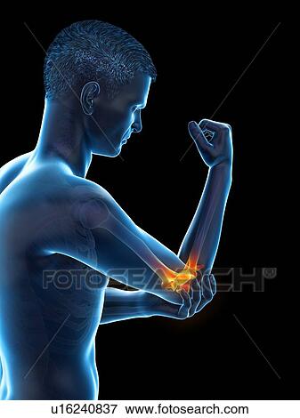 Stock Photo - Elbow pain, conceptual illustration.. Fotosearch