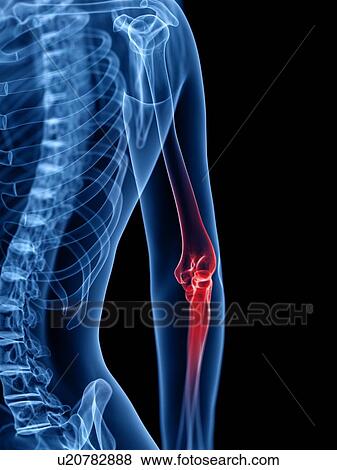 Stock Photo - Elbow pain, conceptual illustration. Fotosearch