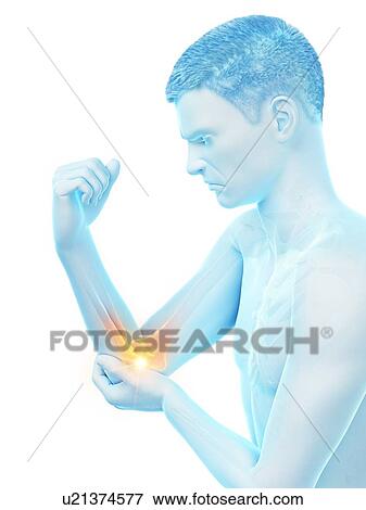 Stock Photo - Elbow pain, conceptual illustration.. Fotosearch