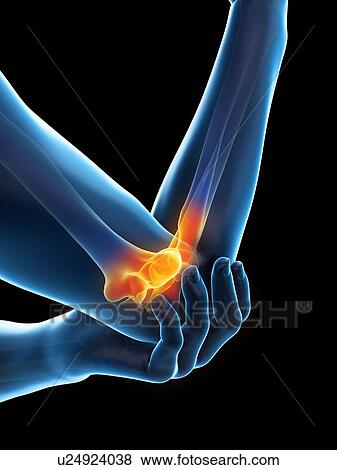 Stock Photo - Elbow pain, conceptual illustration.. Fotosearch