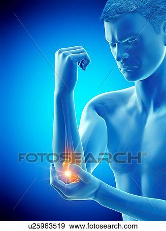 Stock Photo - Elbow pain, conceptual illustration.. Fotosearch
