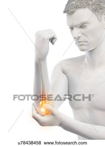 Stock Photo - Elbow pain, conceptual illustration.. Fotosearch