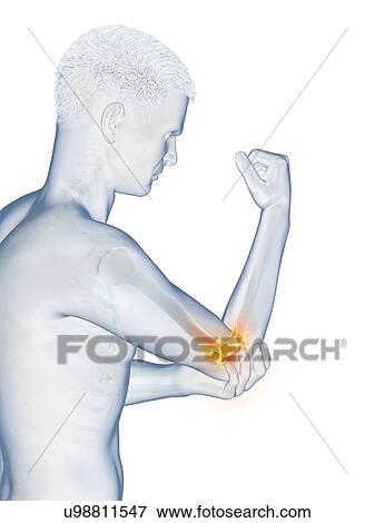 Stock Photo - Elbow pain, conceptual illustration.. Fotosearch