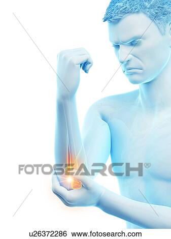 Stock Photograph - Elbow pain, conceptual illustration.. Fotosearch