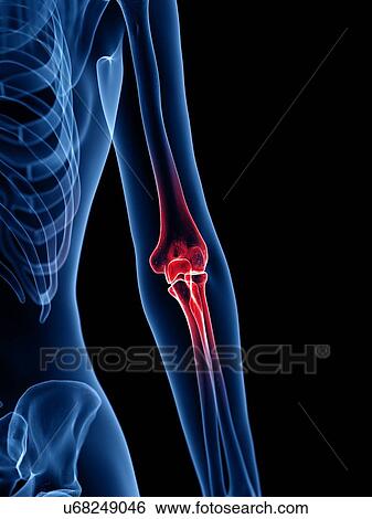 Stock Photograph - Elbow pain, conceptual illustration. Fotosearch