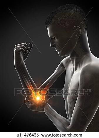Stock Photography - Elbow pain, conceptual illustration.. Fotosearch