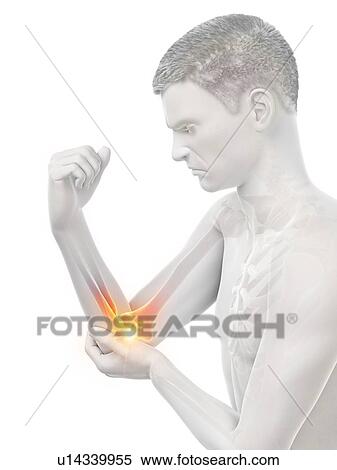 Stock Photography - Elbow pain, conceptual illustration.. Fotosearch