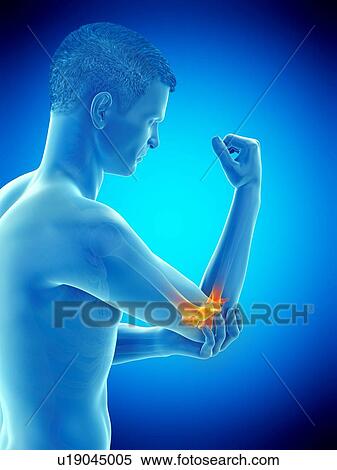 Stock Photography - Elbow pain, conceptual illustration.. Fotosearch