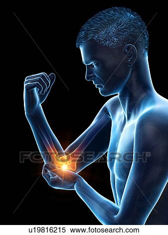 Stock Photography - Elbow pain, conceptual illustration.. Fotosearch