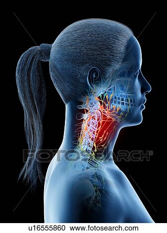 Stock Image - Enlarged lymph nodes, conceptual computer illustration.. Fotosearch