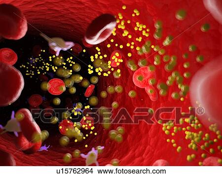 Fat in blood vessels, computer illustration. View Large Photo Image Picture - Fat in blood vessels, computer illustration.. Fotosearch