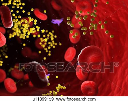 Stock Photo - Fat in blood vessels, computer illustration.. Fotosearch