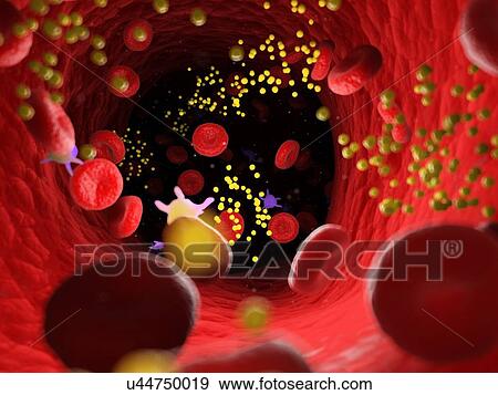 Stock Photo - Fat in blood vessels, computer illustration.. Fotosearch