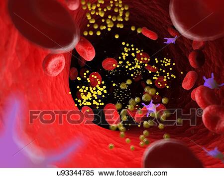 Stock Photography - Fat in blood vessels, computer illustration.. Fotosearch