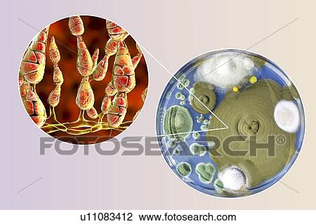 Filamentous allergenic fungus Alternaria alternata, computer illustration of fungal morphology and photograph of fungal colonies on Sabouraud Dextrose Agar. Alternaria is a dematiaceous (phaeoid) fungus commonly isolated from plants, soil, food, and... View Large Photo Image Stock Image - Filamentous allergenic fungus Alternaria alternata, computer illustration of fungal morphology and photograph of fungal colonies on Sabouraud Dextrose Agar. Alternaria is a dematiaceous (phaeoid) fungus commonly isolated from plants, soil, food, and.... Fotosearch