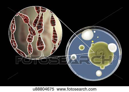 Filamentous allergenic fungus Alternaria alternata, computer illustration of fungal morphology and photograph of fungal colonies on Sabouraud Dextrose Agar. Alternaria is a dematiaceous (phaeoid) fungus commonly isolated from plants, soil, food, and... View Large Photo Image Stock Photography - Filamentous allergenic fungus Alternaria alternata, computer illustration of fungal morphology and photograph of fungal colonies on Sabouraud Dextrose Agar. Alternaria is a dematiaceous (phaeoid) fungus commonly isolated from plants, soil, food, and.... Fotosearch