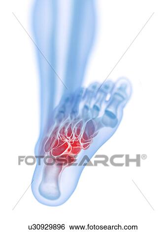 Stock Photograph - Foot pain, conceptual illustration. Fotosearch