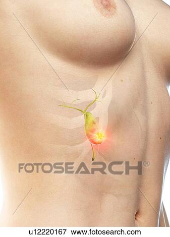 Stock Photo - Gallbladder cancer, conceptual illustration. Fotosearch
