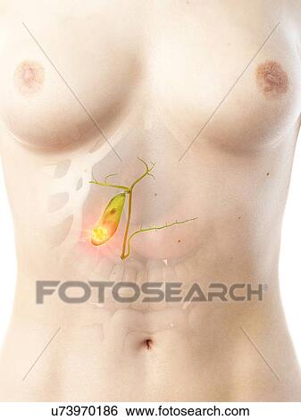 Gallbladder cancer, conceptual illustration View Large Photo Image Stock Photograph - Gallbladder cancer, conceptual illustration. Fotosearch
