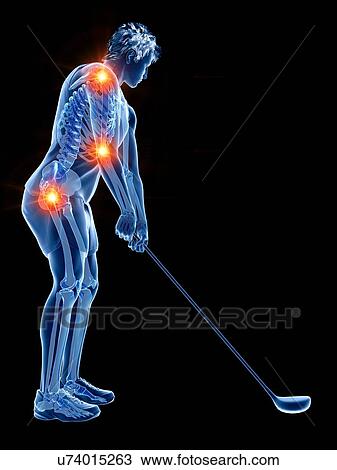 Stock Image - Golf player with painful joints, illustration. Fotosearch