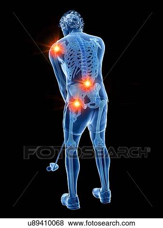 Stock Photo - Golf player with painful joints, illustration. Fotosearch