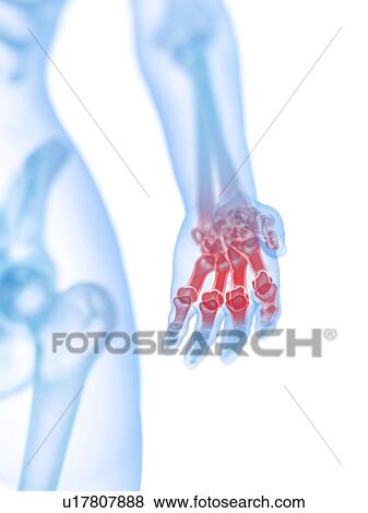 Stock Photo - Hand pain, conceptual illustration. Fotosearch